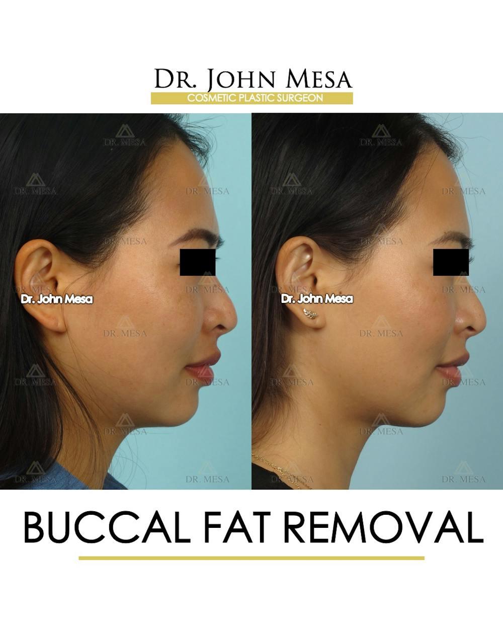 Buccal Fat Pad Removal Before & After Gallery - Patient 174900493 - Image 3
