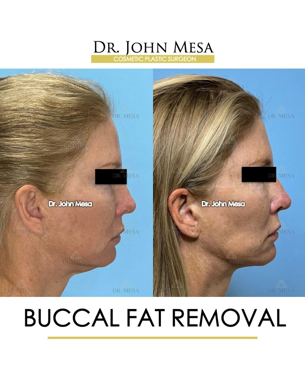 Buccal Fat Pad Removal Before & After Gallery - Patient 174900506 - Image 4