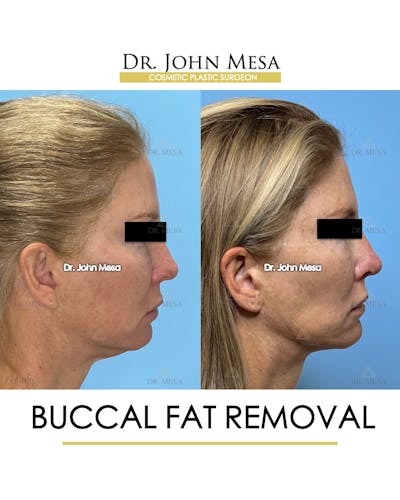 Buccal Fat Pad Removal Before & After Gallery - Patient 174900506 - Image 4