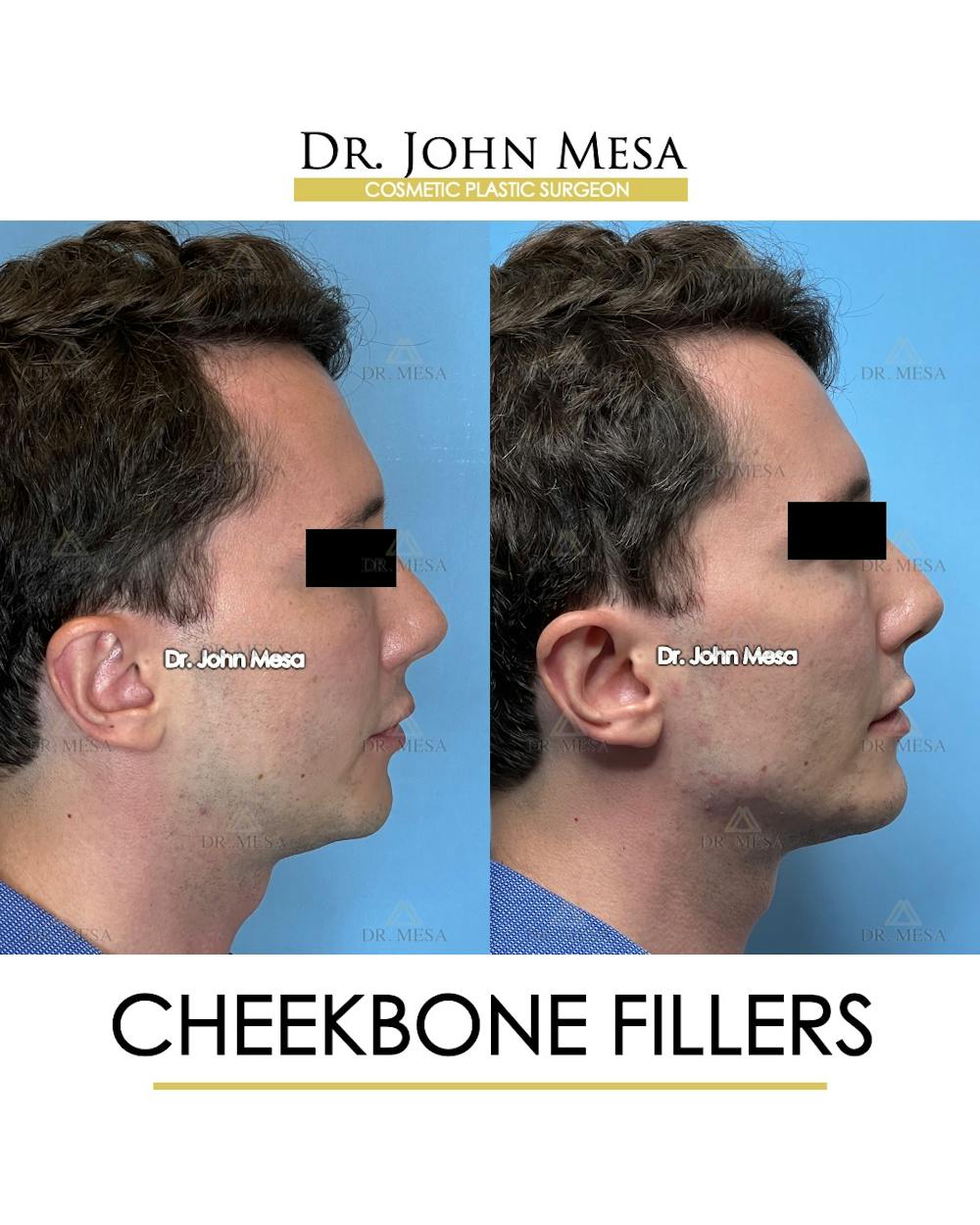 Cheekbone Filler Before & After Gallery - Patient 174901074 - Image 3