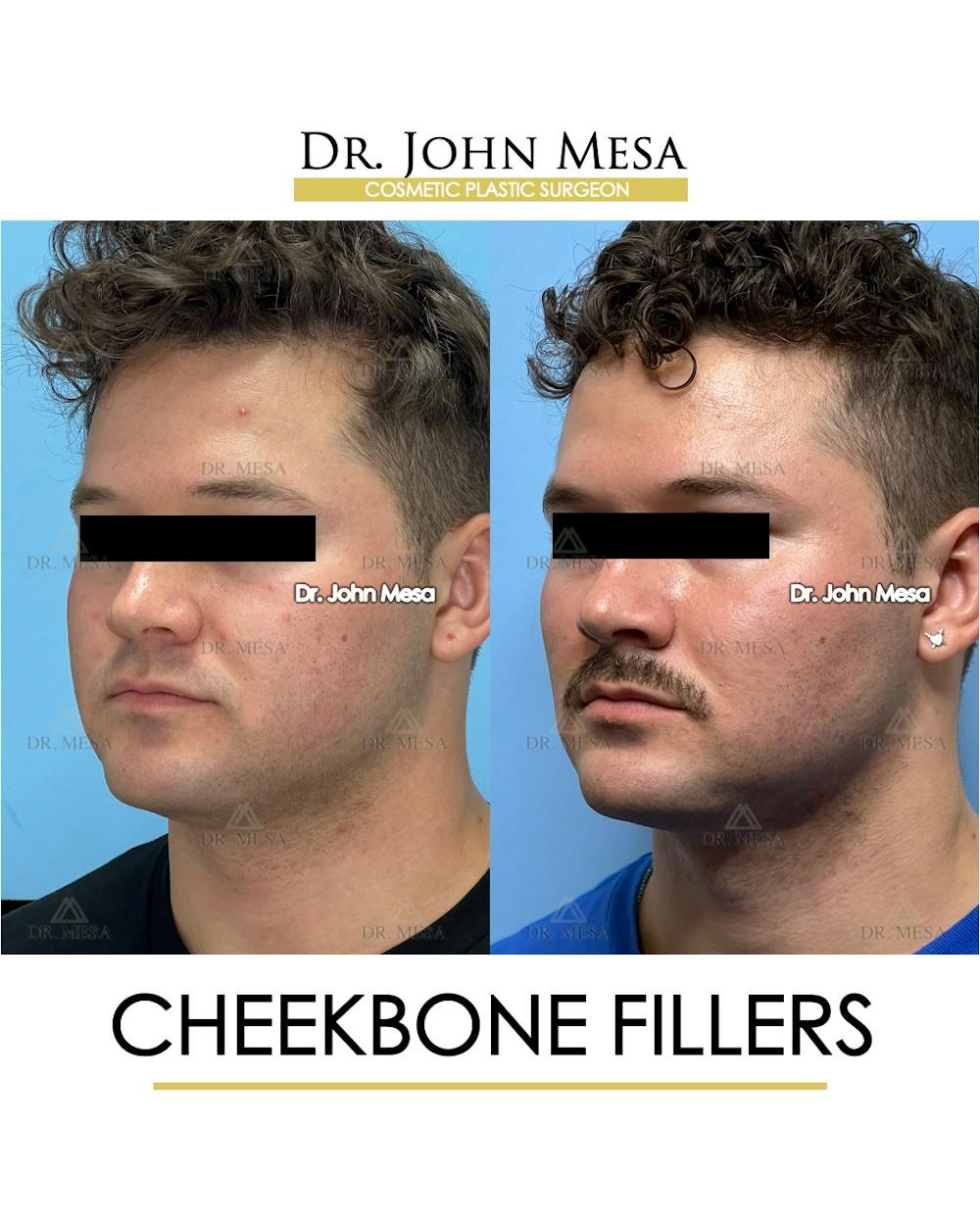 Cheekbone Filler Before & After Gallery - Patient 174900908 - Image 4