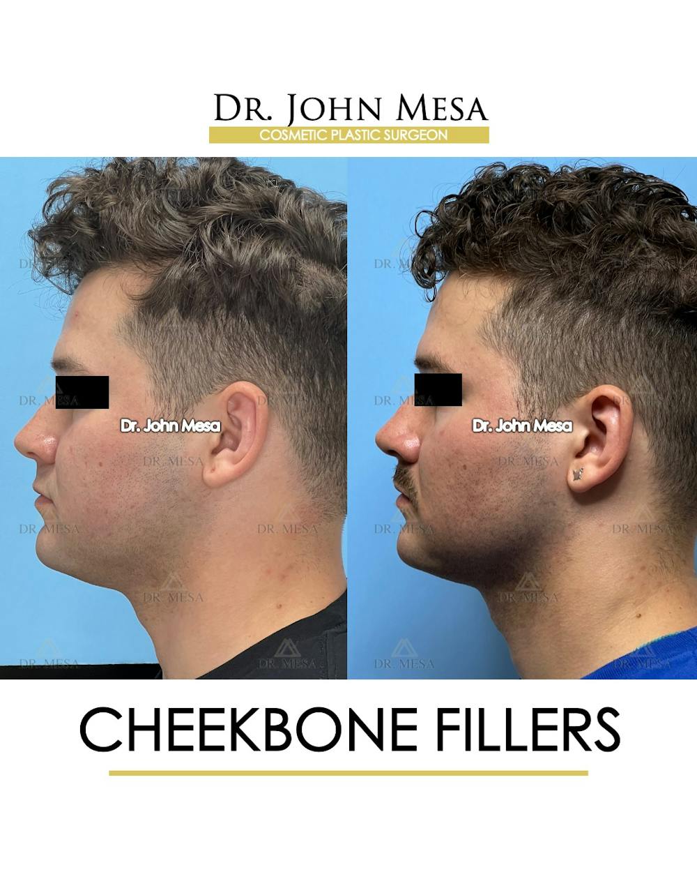 Cheekbone Filler Before & After Gallery - Patient 174900908 - Image 5