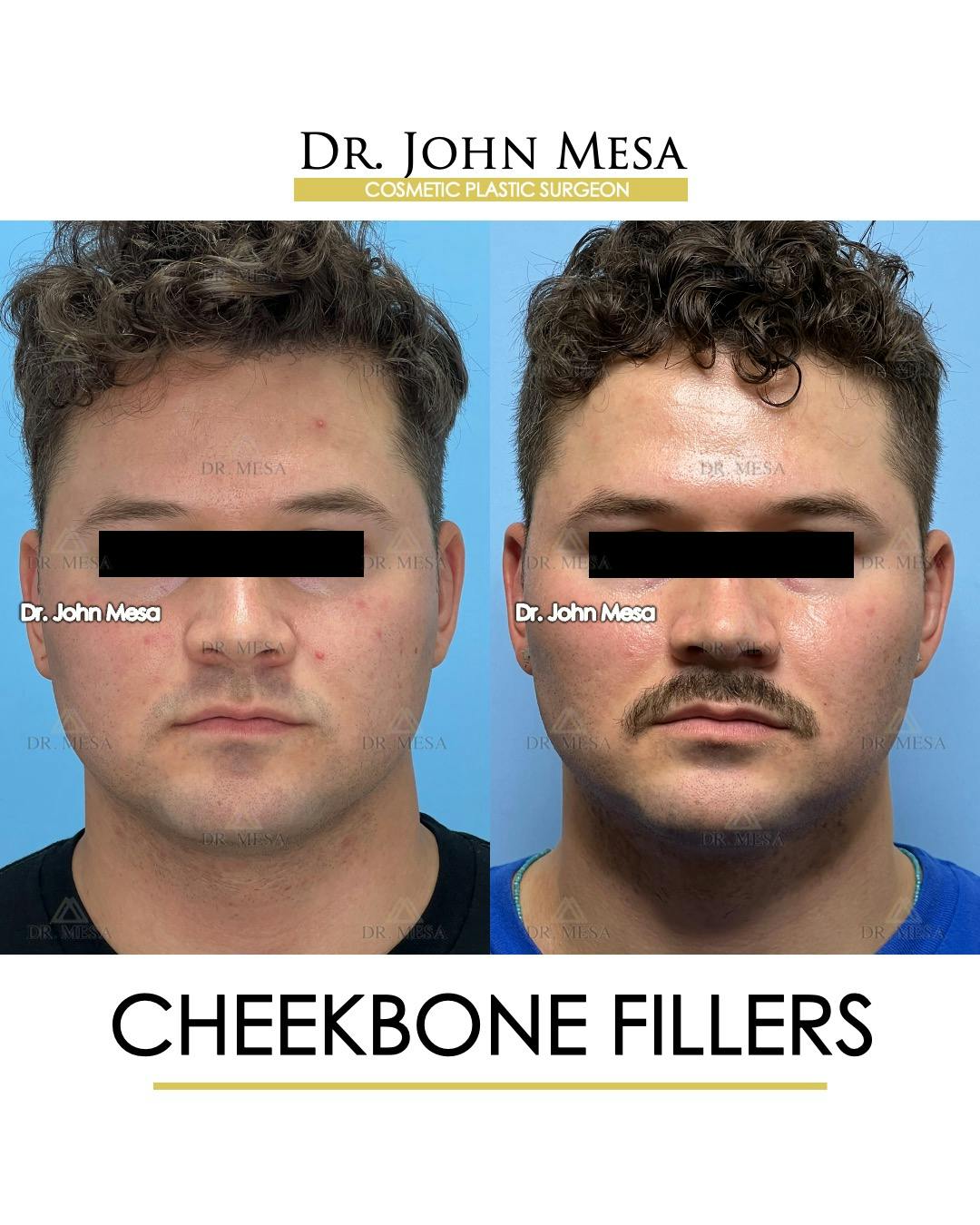 Cheekbone Filler Before & After Gallery - Patient 174900908 - Image 1
