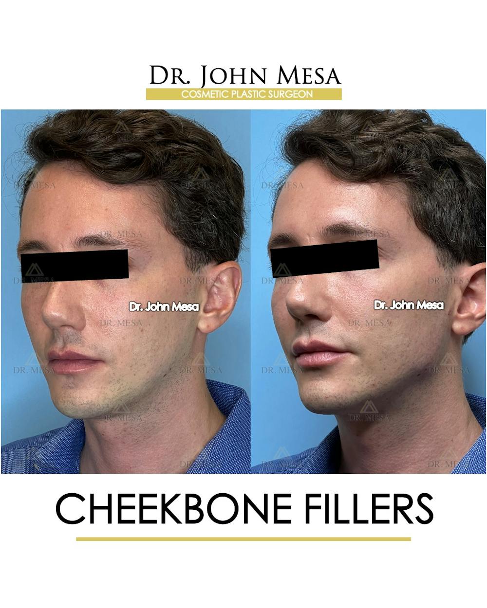 Cheekbone Filler Before & After Gallery - Patient 174901074 - Image 4