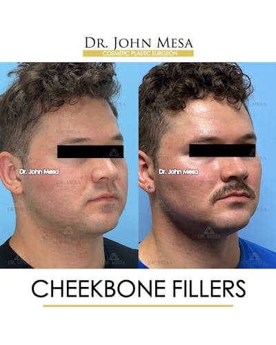 Cheekbone Filler Before & After Gallery - Patient 174900908 - Image 2