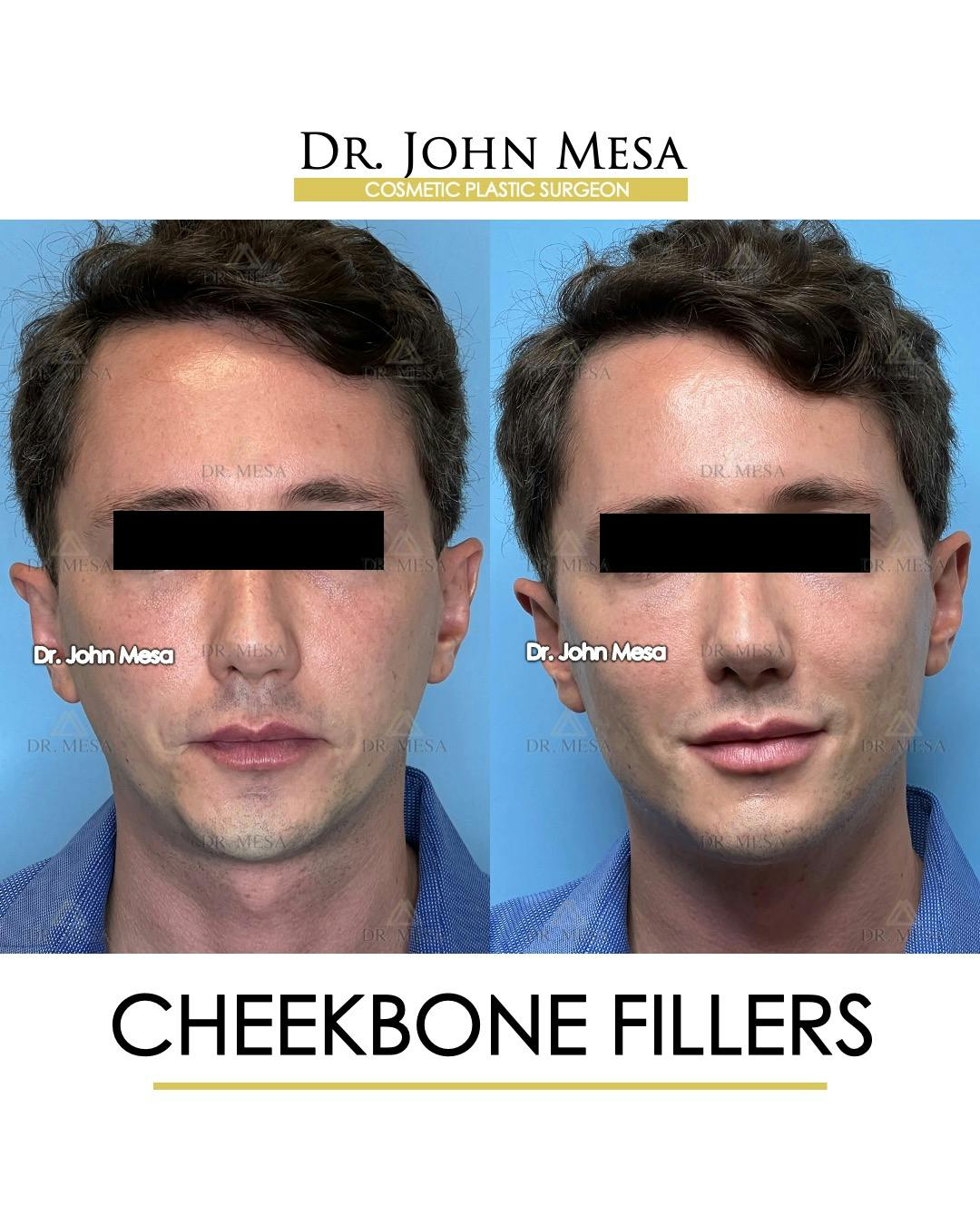 Cheekbone Filler Before & After Gallery - Patient 174901074 - Image 1