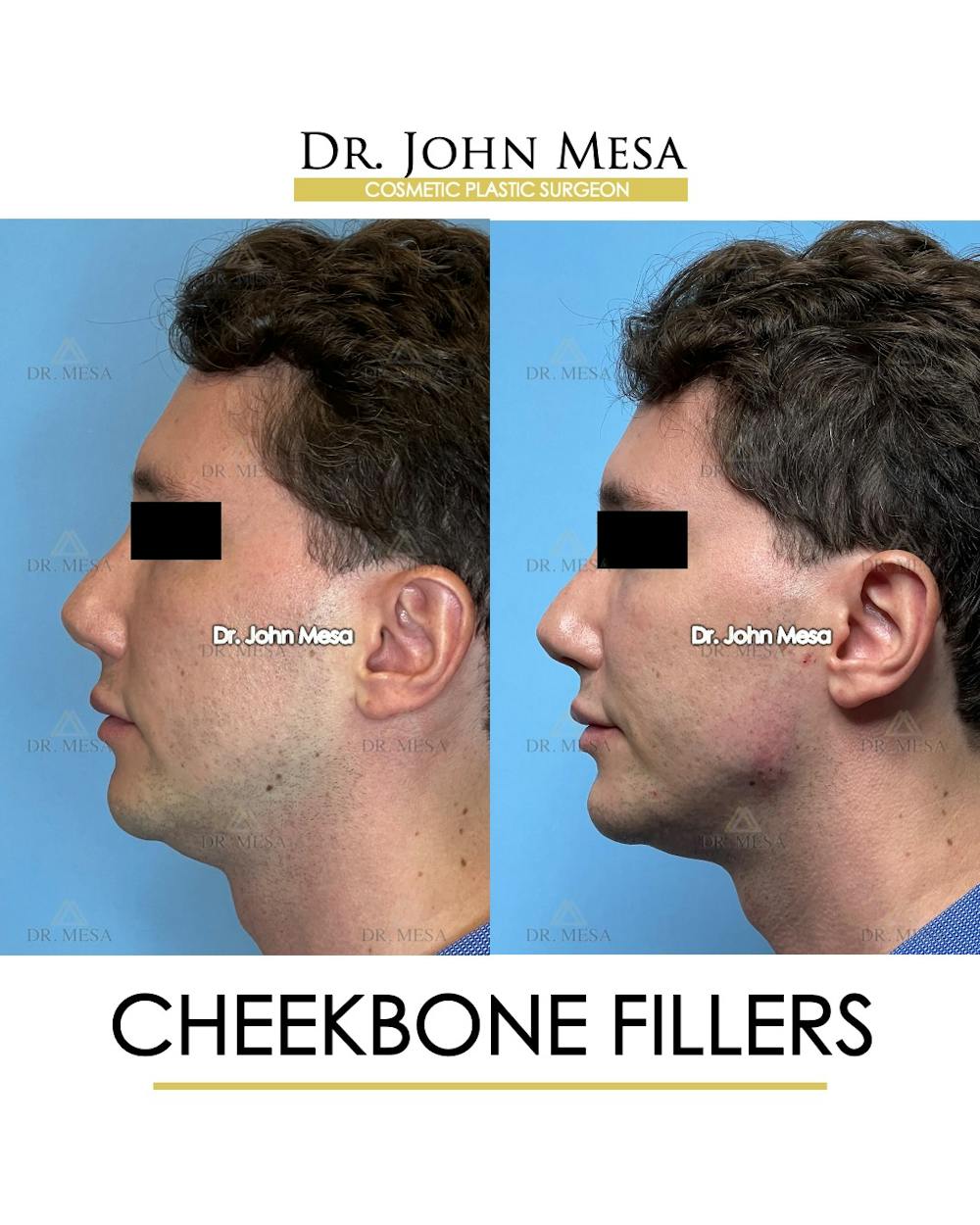 Cheekbone Filler Before & After Gallery - Patient 174901074 - Image 5