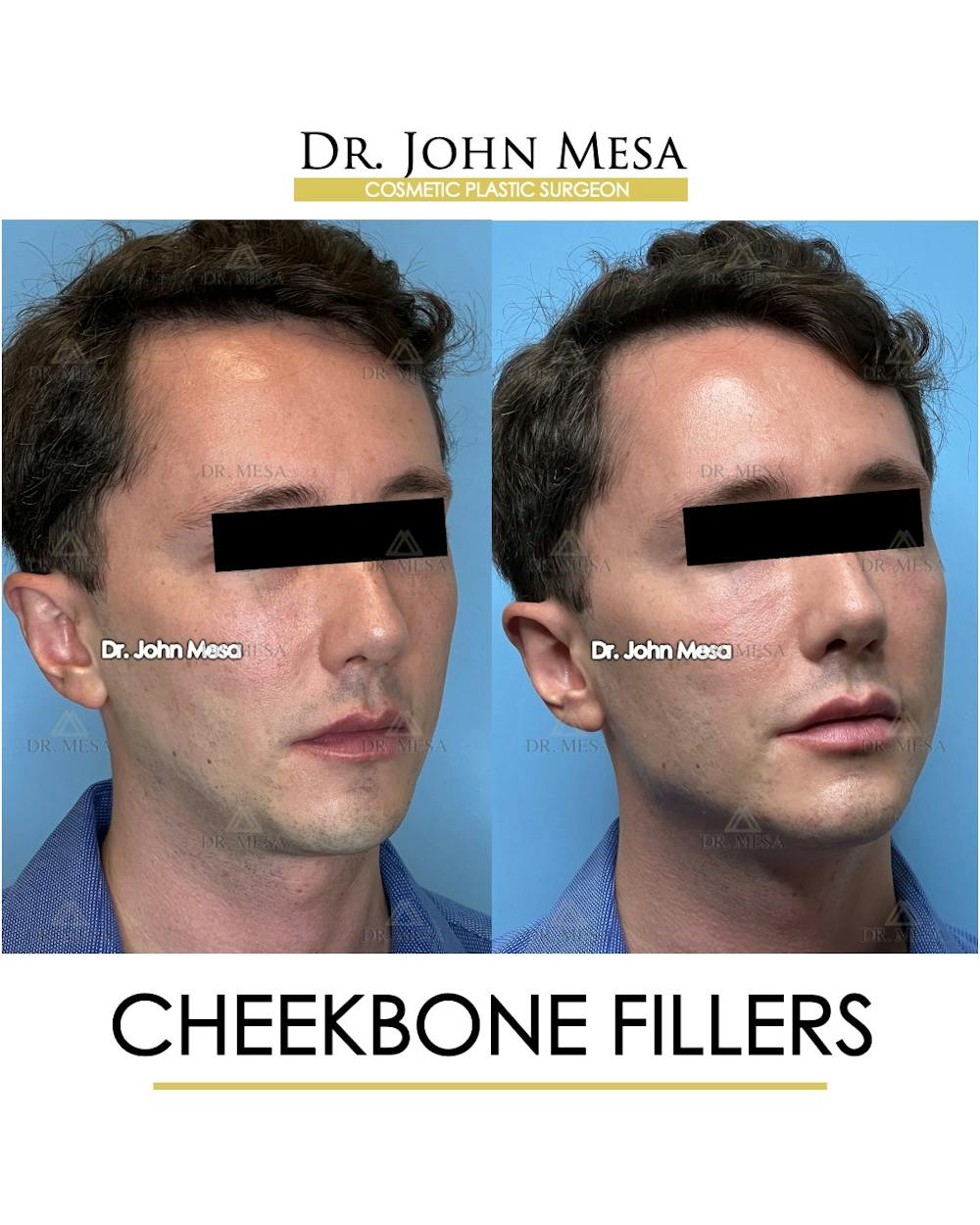Cheekbone Filler Before & After Gallery - Patient 174901074 - Image 2