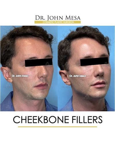 Cheekbone Filler Before & After Gallery - Patient 174901074 - Image 2