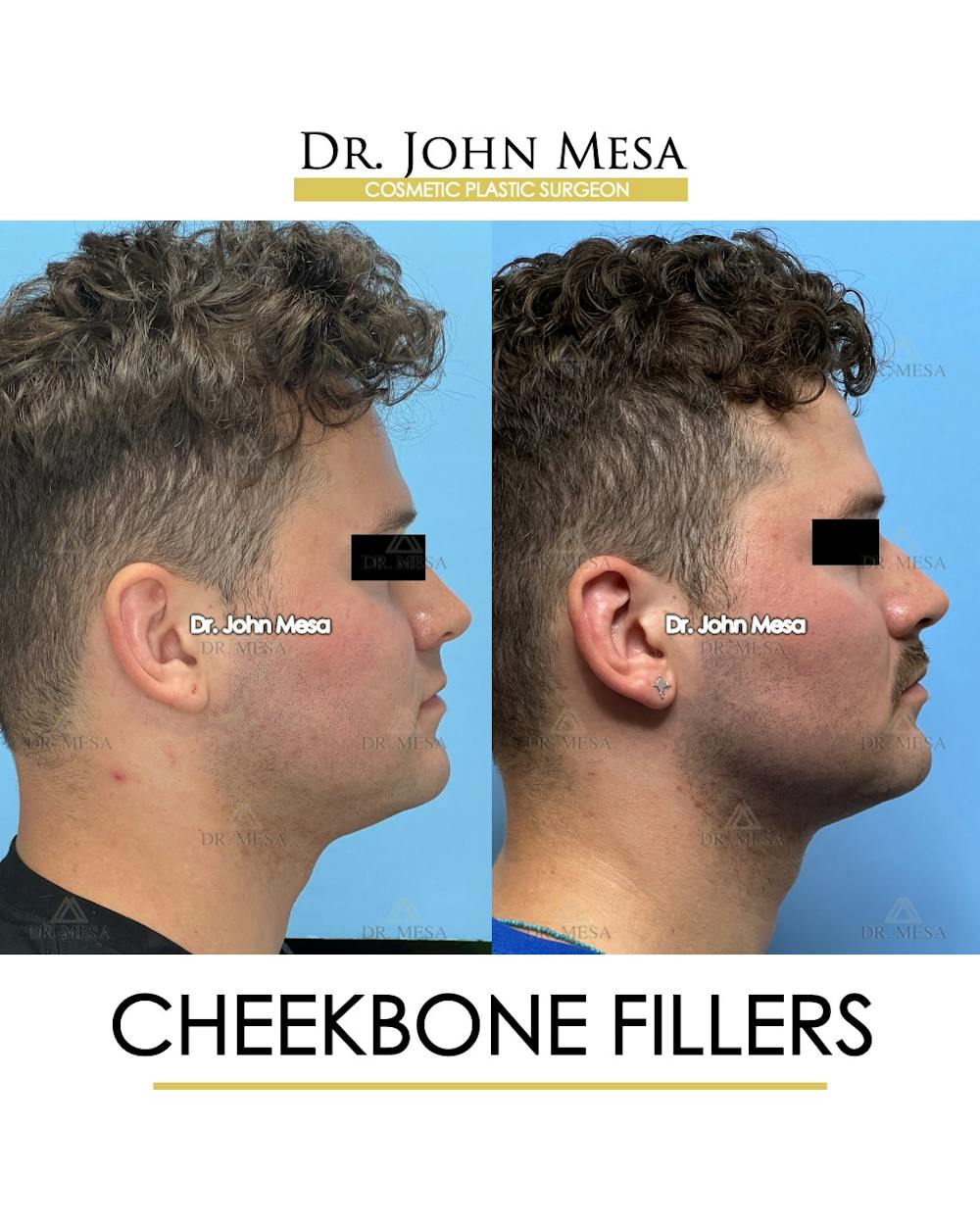Cheekbone Filler Before & After Gallery - Patient 174900908 - Image 3