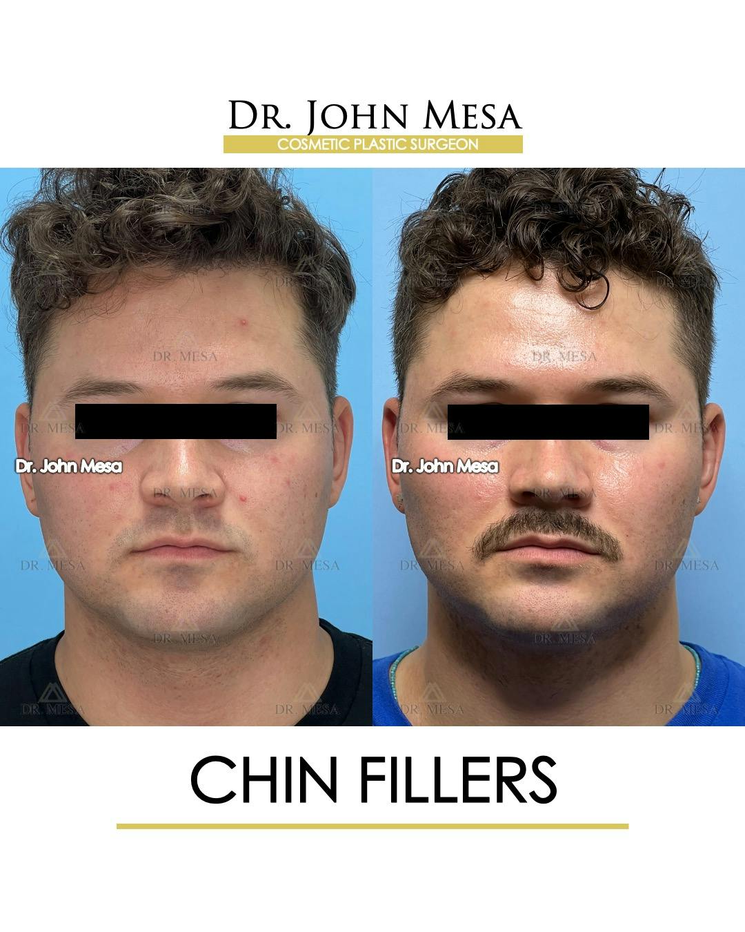 Chin Filler Before & After Gallery - Patient 174901723 - Image 1