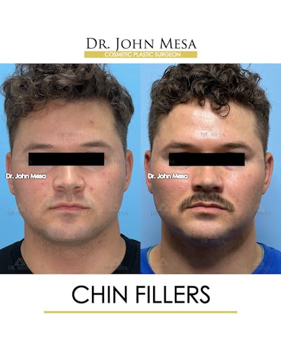 Chin Filler Before & After Gallery - Patient 174901723 - Image 1