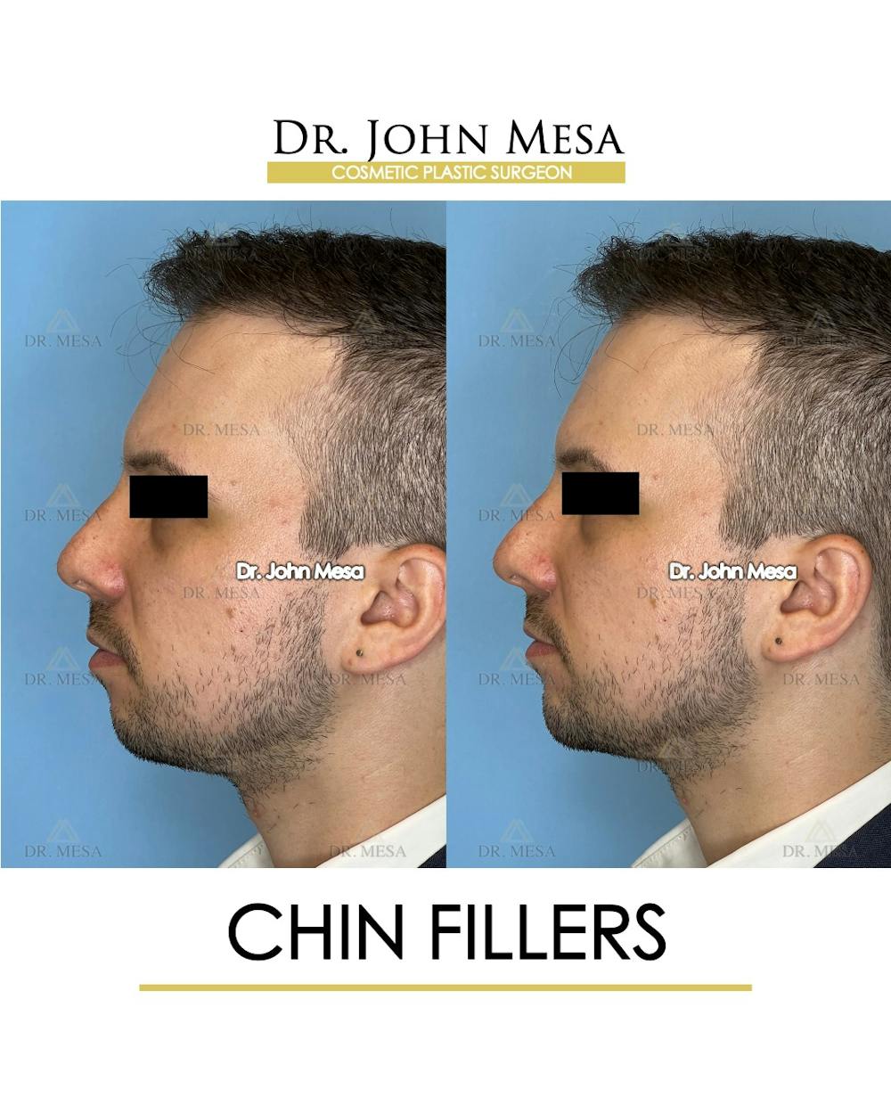 Chin Filler Before & After Gallery - Patient 174902000 - Image 5