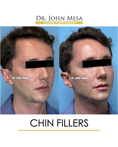 Chin Filler Before & After Gallery - Patient 174901999 - Image 2