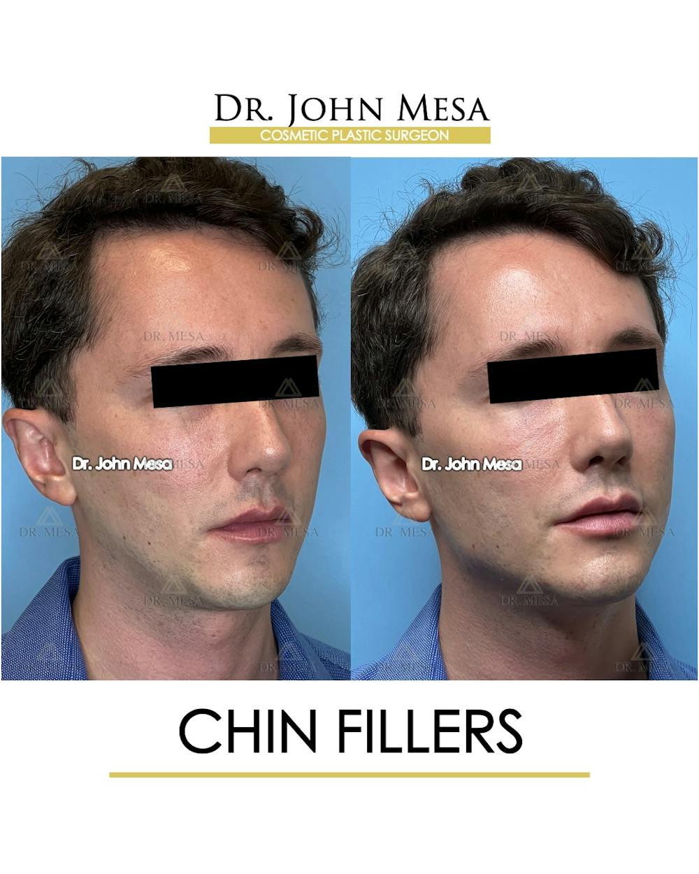 Chin Filler Before & After Gallery - Patient 174901999 - Image 2