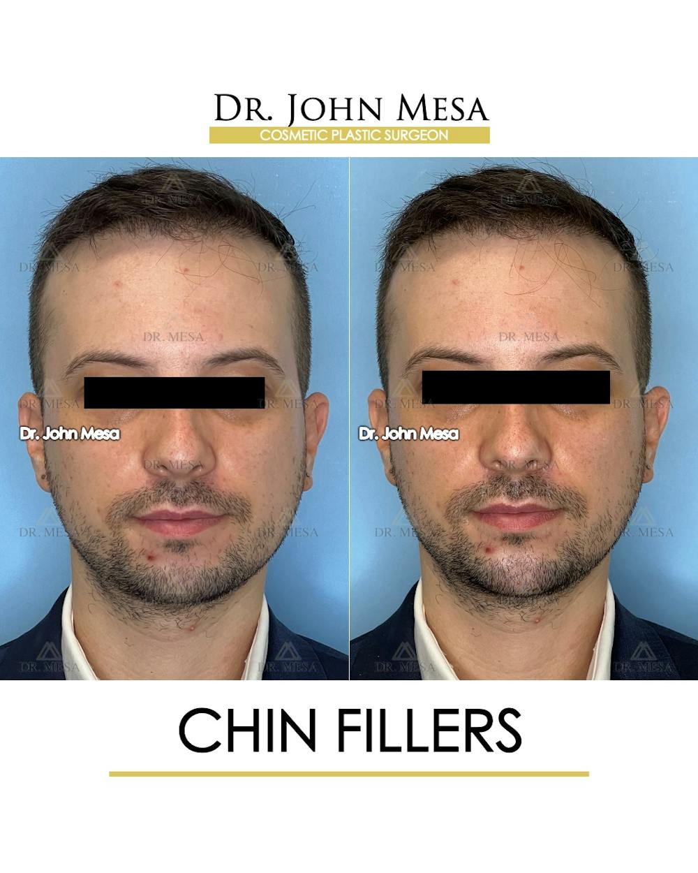 Chin Filler Before & After Gallery - Patient 174902000 - Image 1