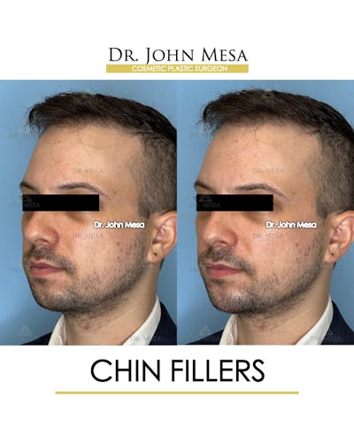 Chin Filler Before & After Gallery - Patient 174902000 - Image 2