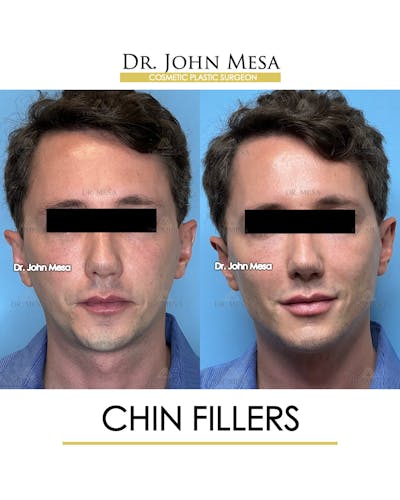 Chin Filler Before & After Gallery - Patient 174901999 - Image 1