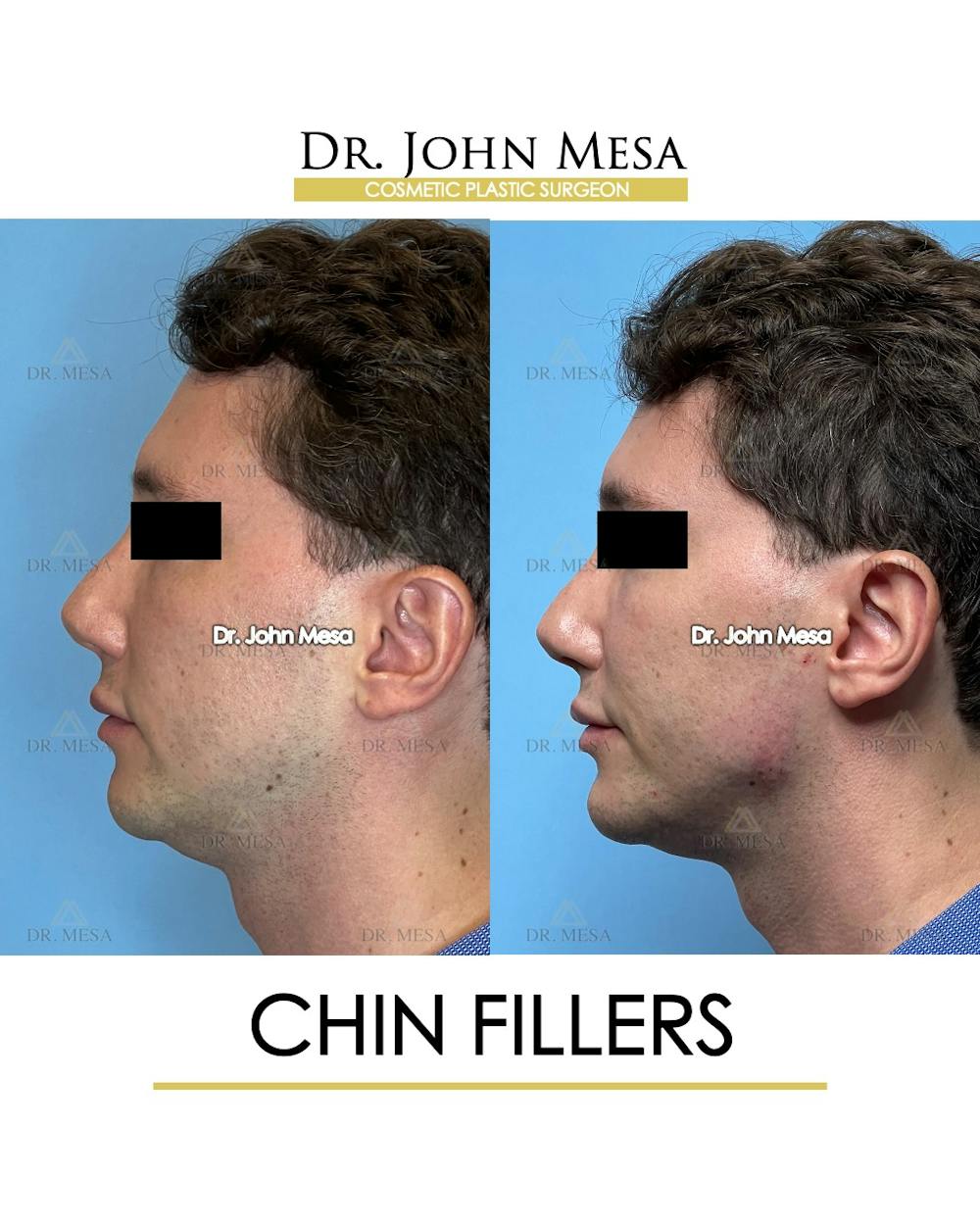 Chin Filler Before & After Gallery - Patient 174901999 - Image 5