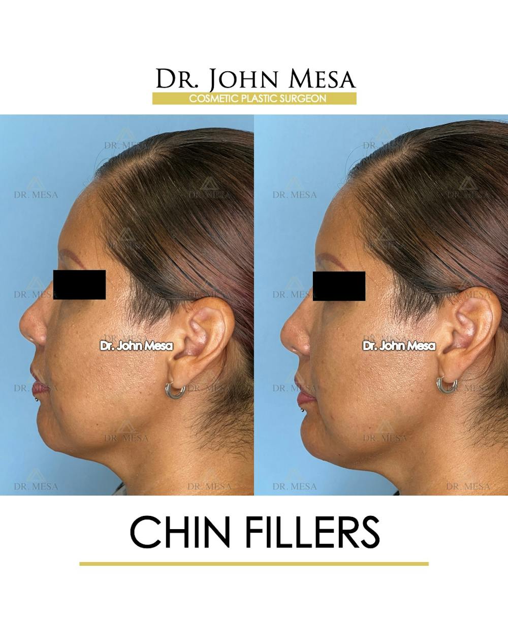 Chin Filler Before & After Gallery - Patient 174902001 - Image 5