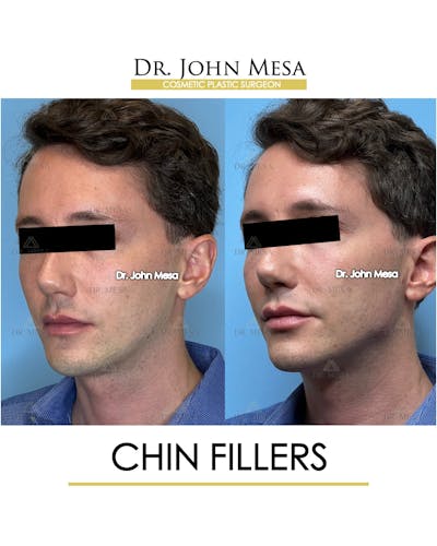 Chin Filler Before & After Gallery - Patient 174901999 - Image 4