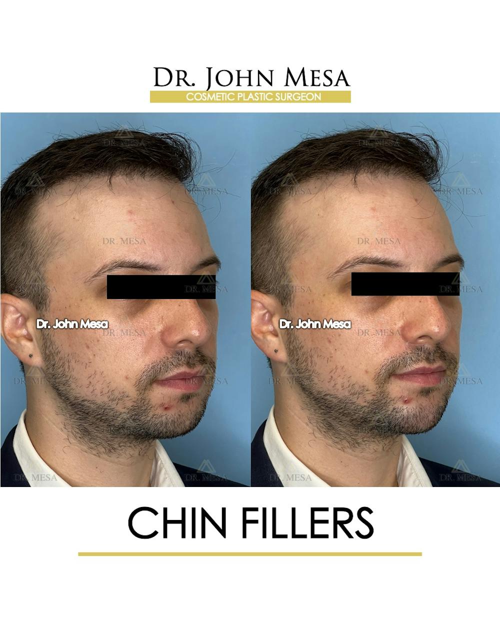 Chin Filler Before & After Gallery - Patient 174902000 - Image 3