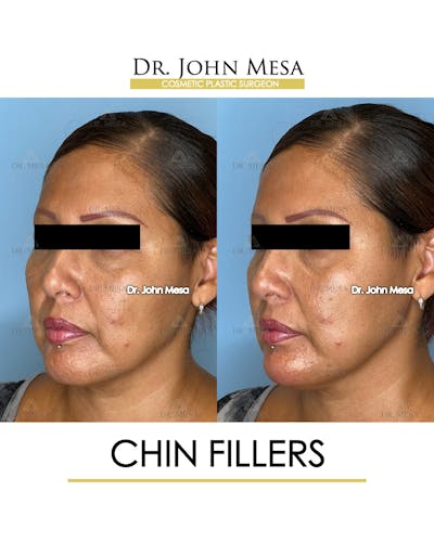 Chin Filler Before & After Gallery - Patient 174902001 - Image 4