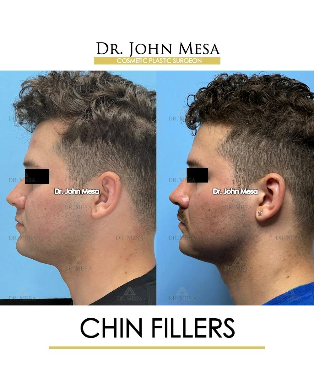 Chin Filler Before & After Gallery - Patient 174901723 - Image 5