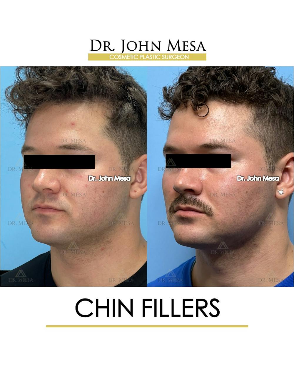 Chin Filler Before & After Gallery - Patient 174901723 - Image 4