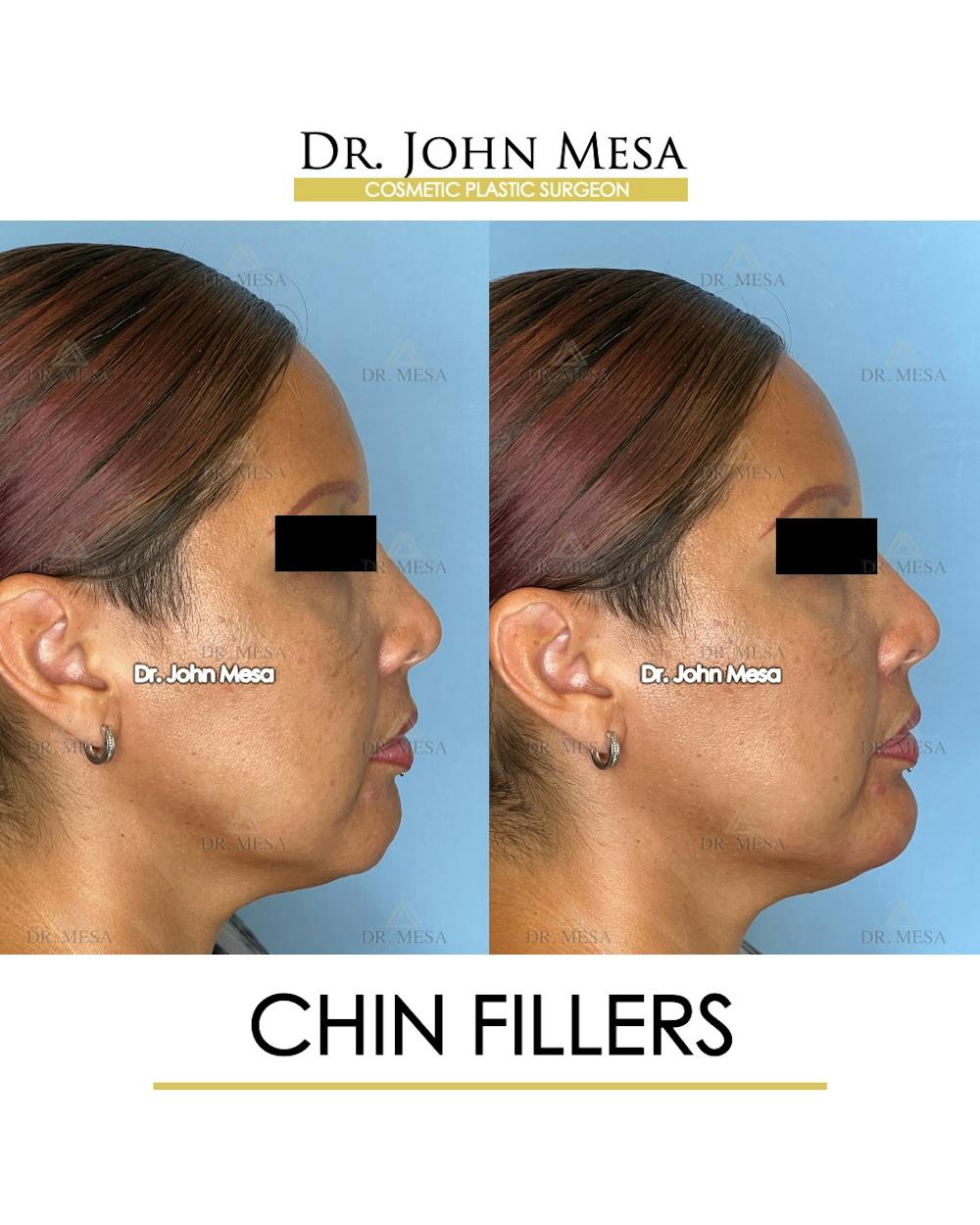 Chin Filler Before & After Gallery - Patient 174902001 - Image 3
