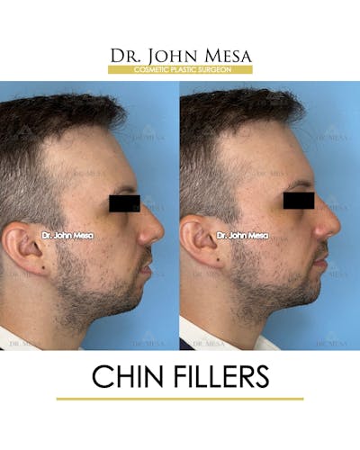 Chin Filler Before & After Gallery - Patient 174902000 - Image 4