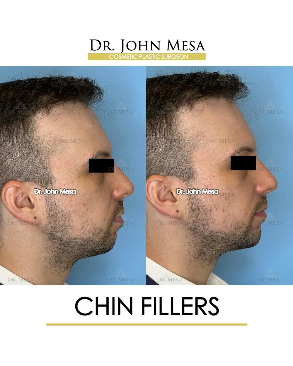 Chin Filler Before & After Gallery - Patient 174902000 - Image 4