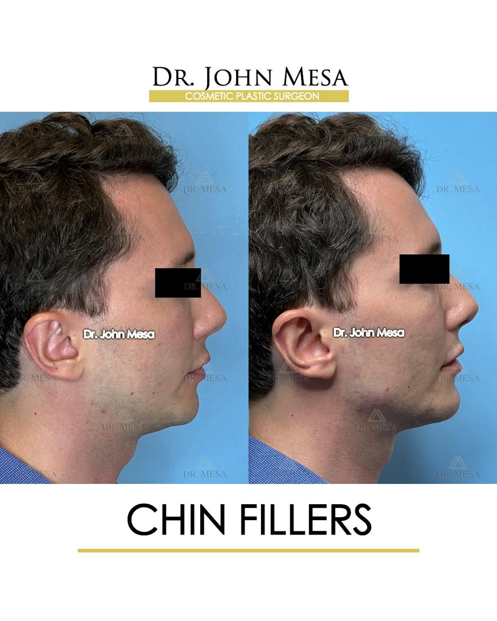 Chin Filler Before & After Gallery - Patient 174901999 - Image 3