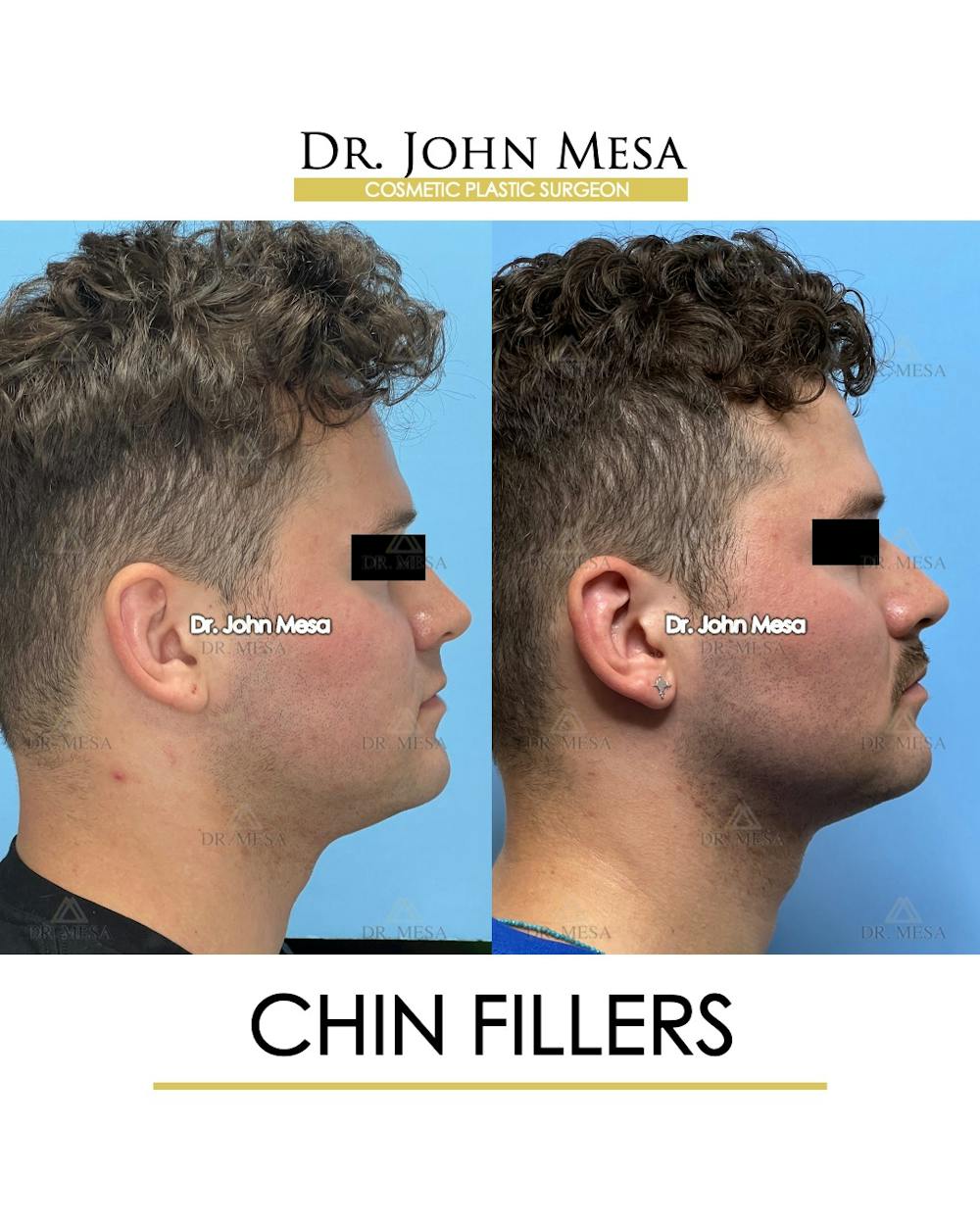 Chin Filler Before & After Gallery - Patient 174901723 - Image 3