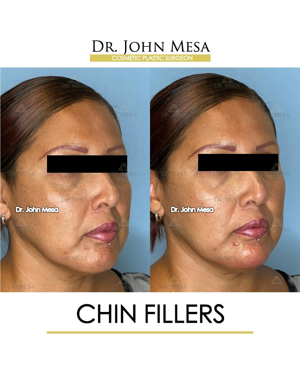 Chin Filler Before & After Gallery - Patient 174902001 - Image 2