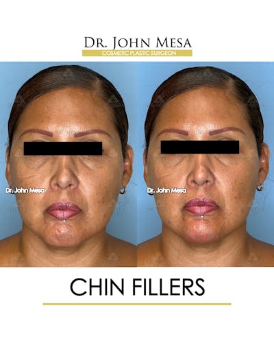 Chin Filler Before & After Gallery - Patient 174902001 - Image 1
