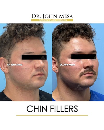Chin Filler Before & After Gallery - Patient 174901723 - Image 2