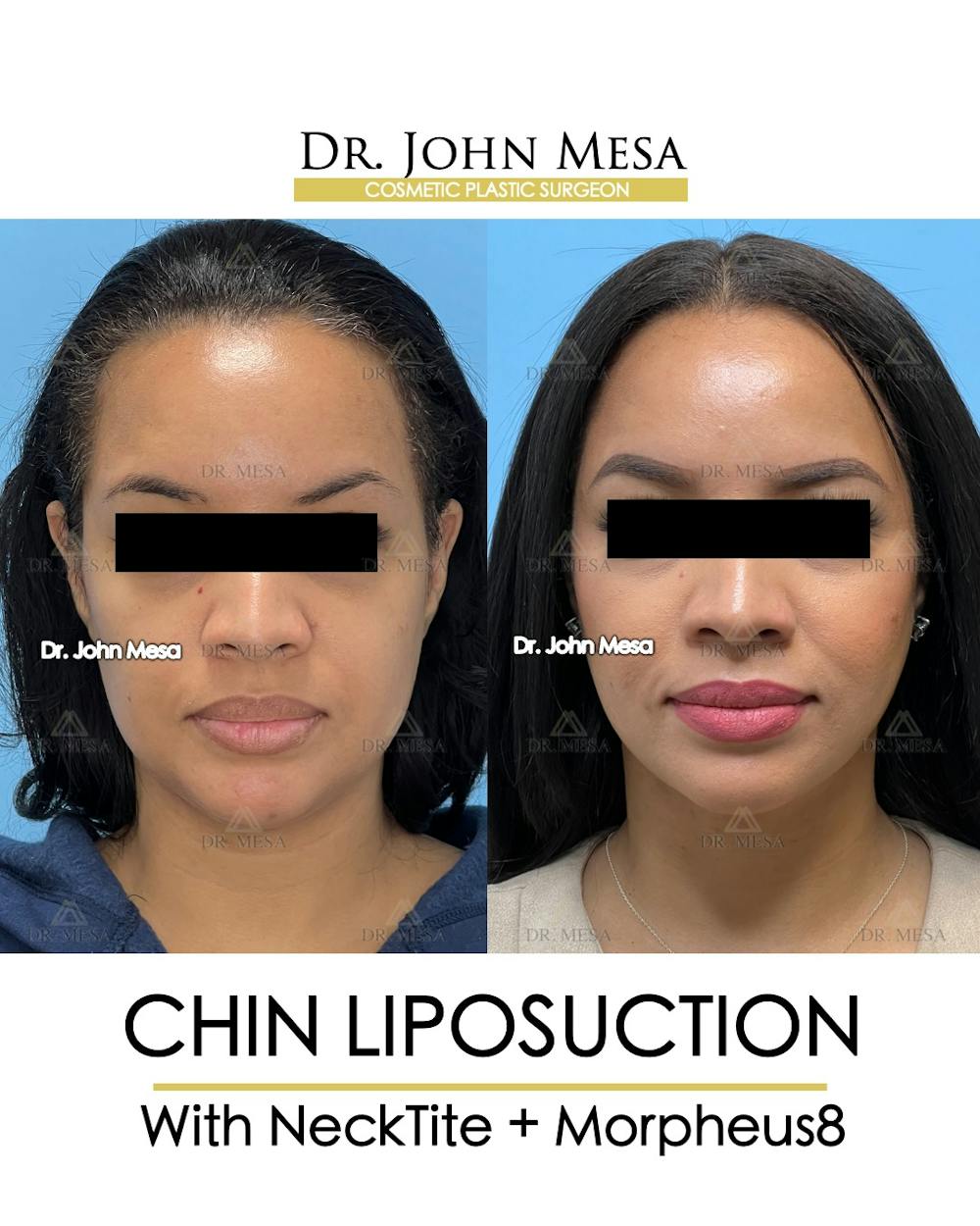 Chin Liposuction Before & After Gallery - Patient 174902184 - Image 2