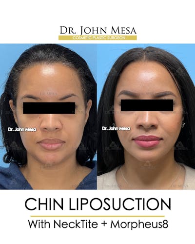 Chin Liposuction Before & After Gallery - Patient 174902184 - Image 2