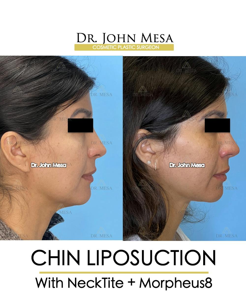 Chin Liposuction Before & After Gallery - Patient 174902409 - Image 1