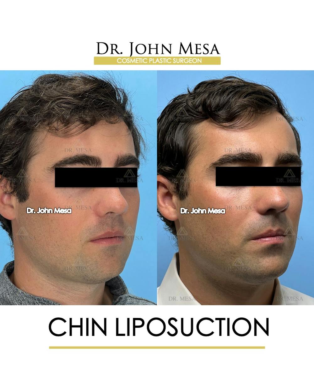 Chin Liposuction Before & After Gallery - Patient 174902005 - Image 3