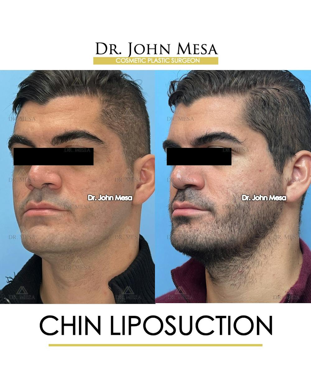 Chin Liposuction Before & After Gallery - Patient 174902008 - Image 4