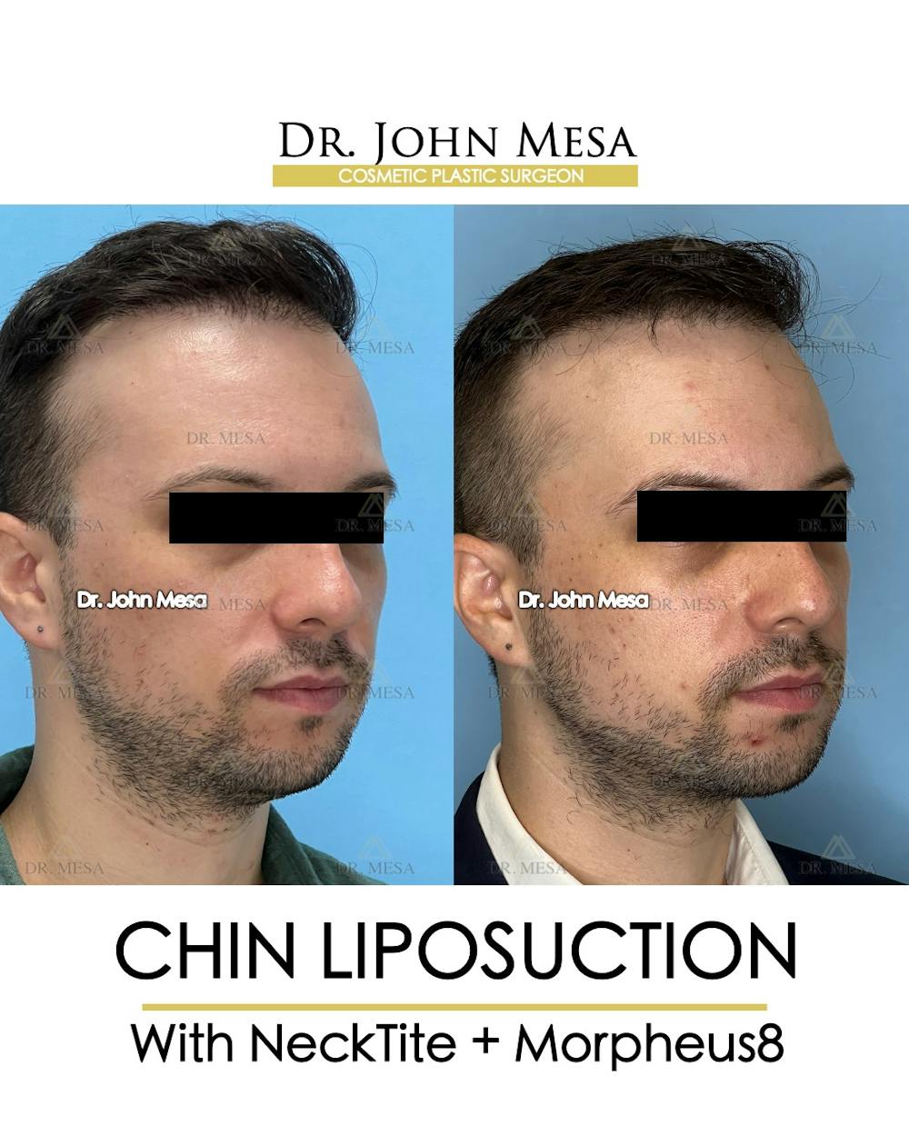 Chin Liposuction Before & After Gallery - Patient 174902009 - Image 3