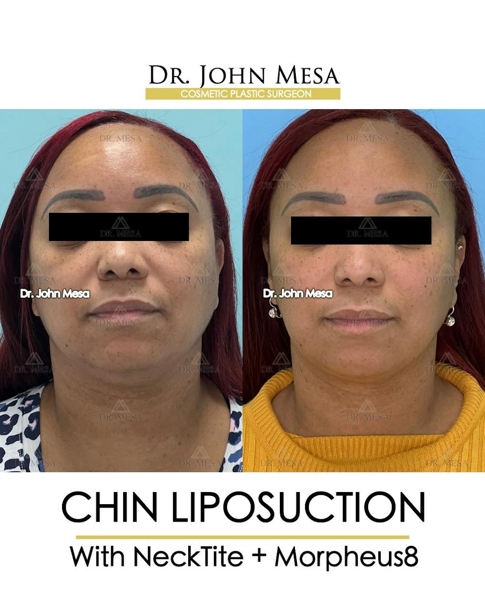 Chin Liposuction Before & After Gallery - Patient 174902327 - Image 2