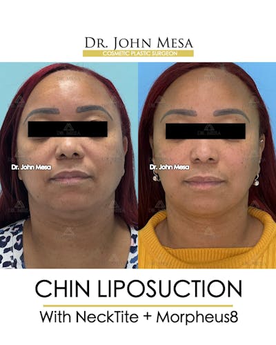 Chin Liposuction Before & After Gallery - Patient 174902327 - Image 2