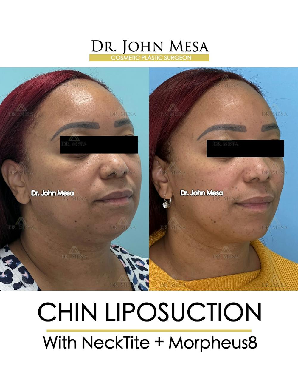 Chin Liposuction Before & After Gallery - Patient 174902327 - Image 3