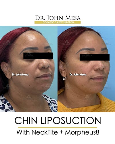 Chin Liposuction Before & After Gallery - Patient 174902327 - Image 2