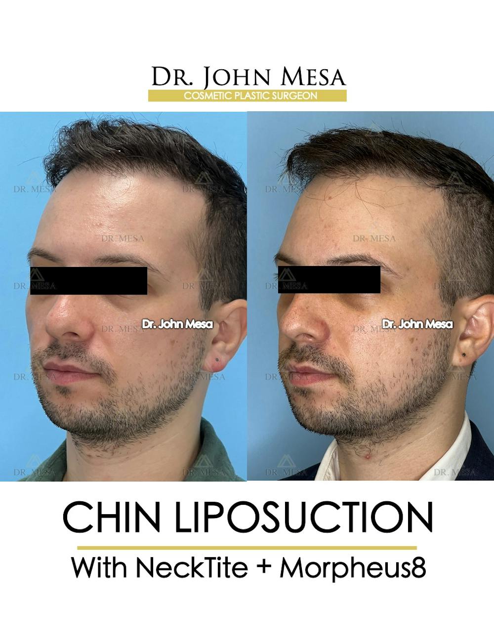 Chin Liposuction Before & After Gallery - Patient 174902009 - Image 4