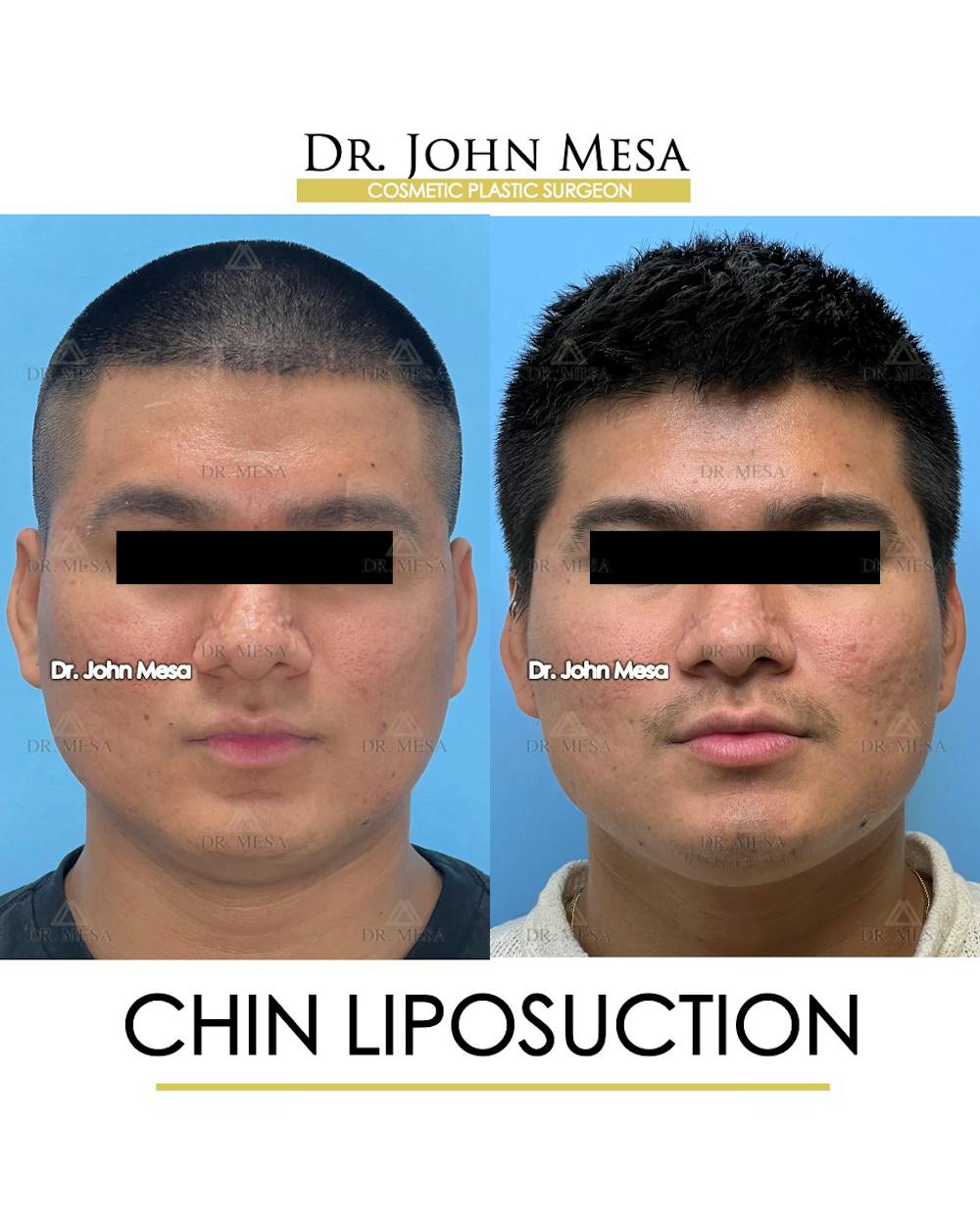 Chin Liposuction Before & After Gallery - Patient 174902006 - Image 2