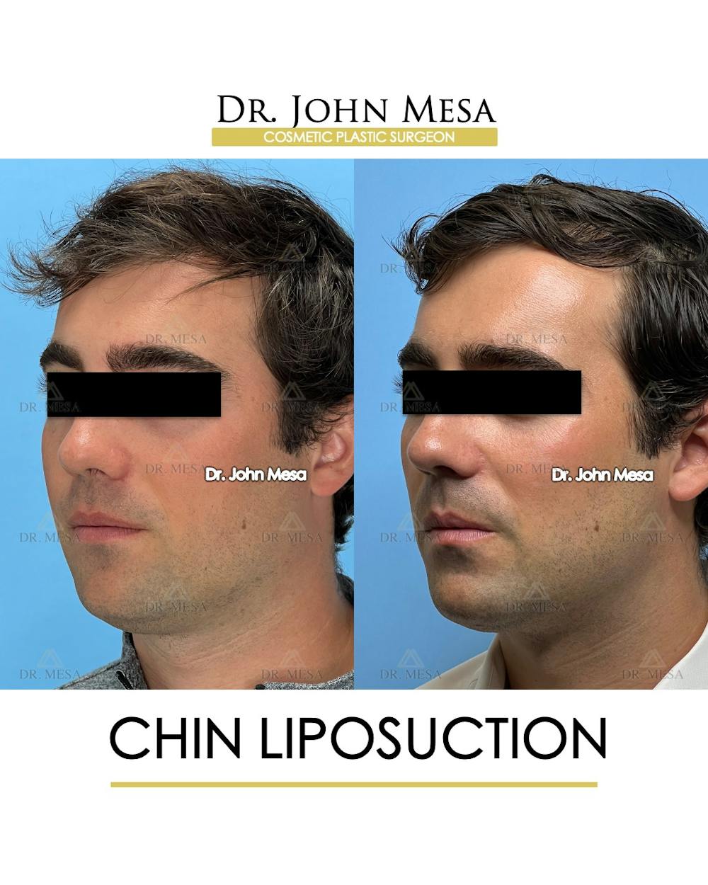 Chin Liposuction Before & After Gallery - Patient 174902005 - Image 5